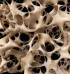 Diagnostika a léčba osteoporózy (1)